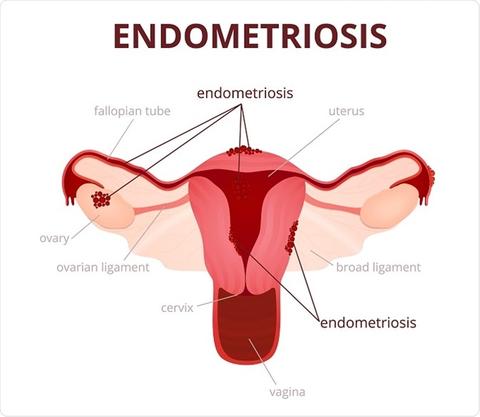 Normal Menstrual Cramps or Endometriosis: How to Tell the Difference:  OB-GYN Associates of Marietta: Obstetrics and Gynecologist